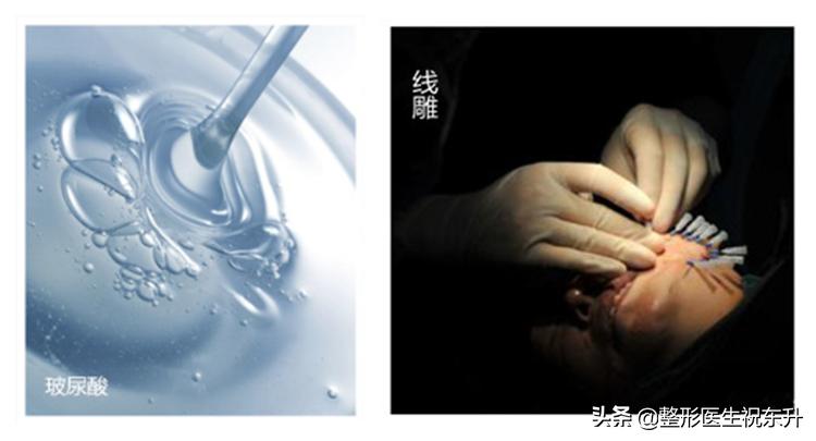 线雕和玻尿酸填充法令纹哪个安全,玻尿酸填充法令纹好还是线雕好呢