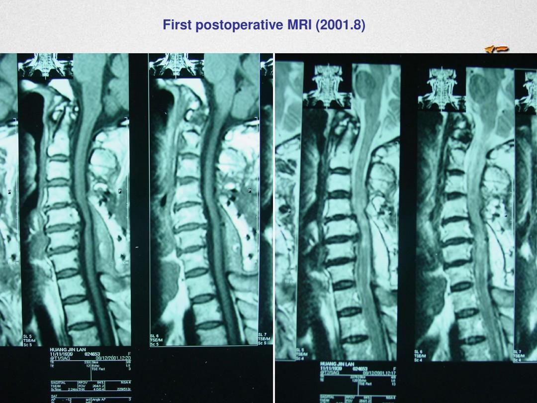 胸锁乳突肌病变痉挛时可引起斜颈,胸锁乳突肌和痉挛性斜颈有关系吗