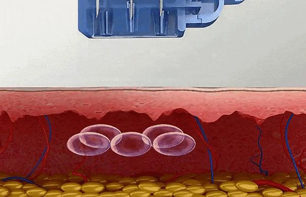 美白微针和水光针的区别,水光针和微针光子嫩肤哪个好