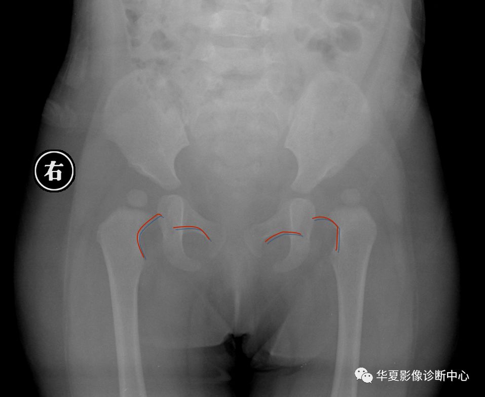 先天性髋关节脱位截骨术全过程,先天性髋关节脱位可以考驾驶证吗