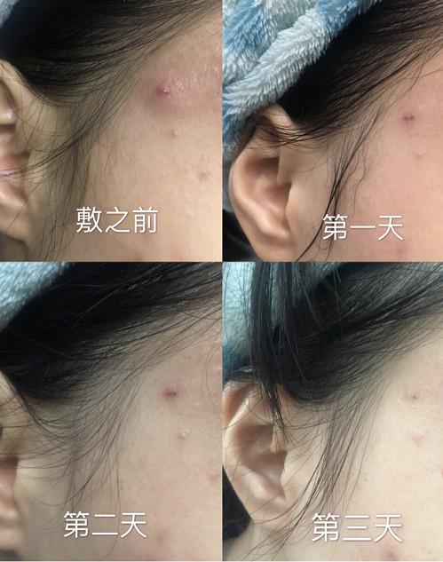 医美面膜大合集教你怎么选,烂脸救星来了最近大火的医美面膜