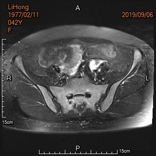 宫外孕保守治疗显示子宫腺肌症,子宫腺肌病保守治疗无效怎么办