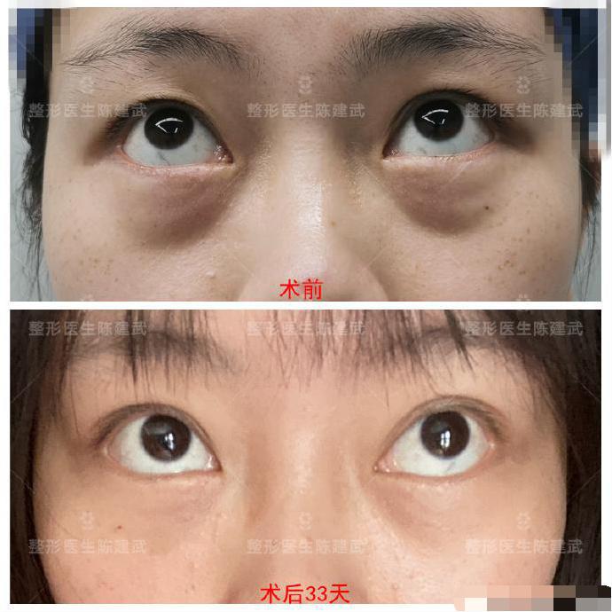 眼袋泪沟做完的恢复的视频,眼袋术后下眼睑塌陷怎么修复