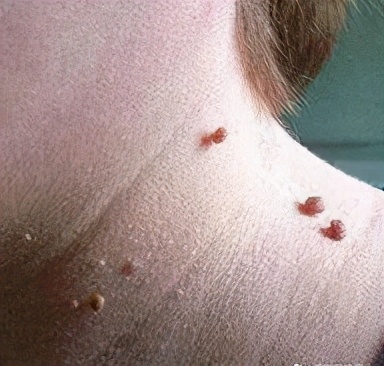 脸上长了闭口小颗粒怎么去除,脸上白色颗粒怎么去除