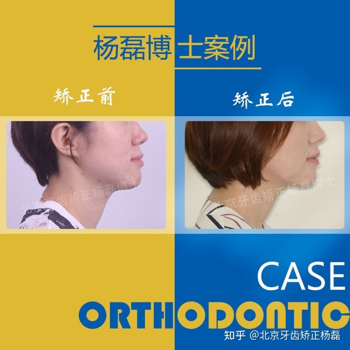 北京牙齿矫正大约要多少钱,北京哪个医院看牙齿矫正比较好