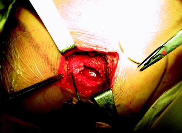 肩袖损伤要怎么处理,肩袖损伤专用膏药