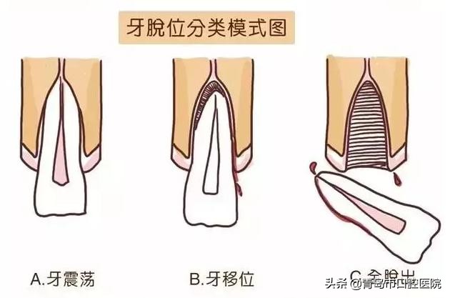 孩子摔断牙不要一扔了之，家长这么做可以让牙齿“起死回生”