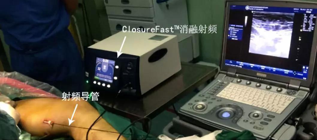 北京协和医院叶炜教授,北京协和医院静脉曲张专家