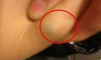 脂肪瘤图片,脂肪瘤变成恶性肿瘤的概率