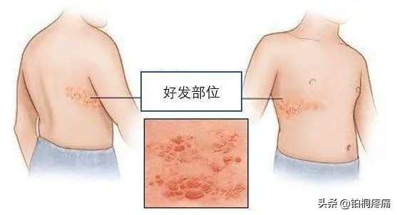 得了带状疱疹疼痛怎么办,带状疱疹有一点痛是不是快好了