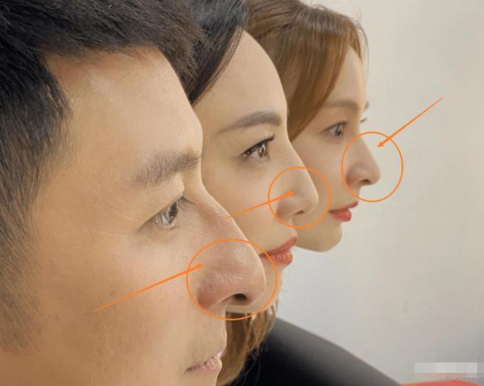 鹰钩鼻很丑吗,鹰钩鼻丑陋