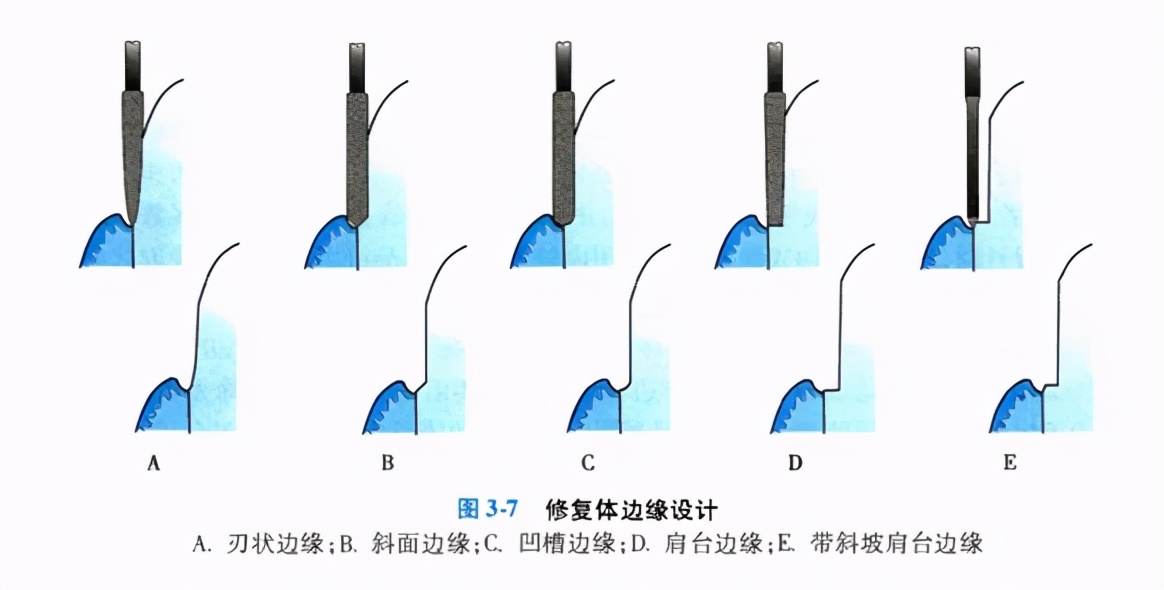 牙齿缺损修复去哪家牙科医院,牙科门牙缺损修复照片