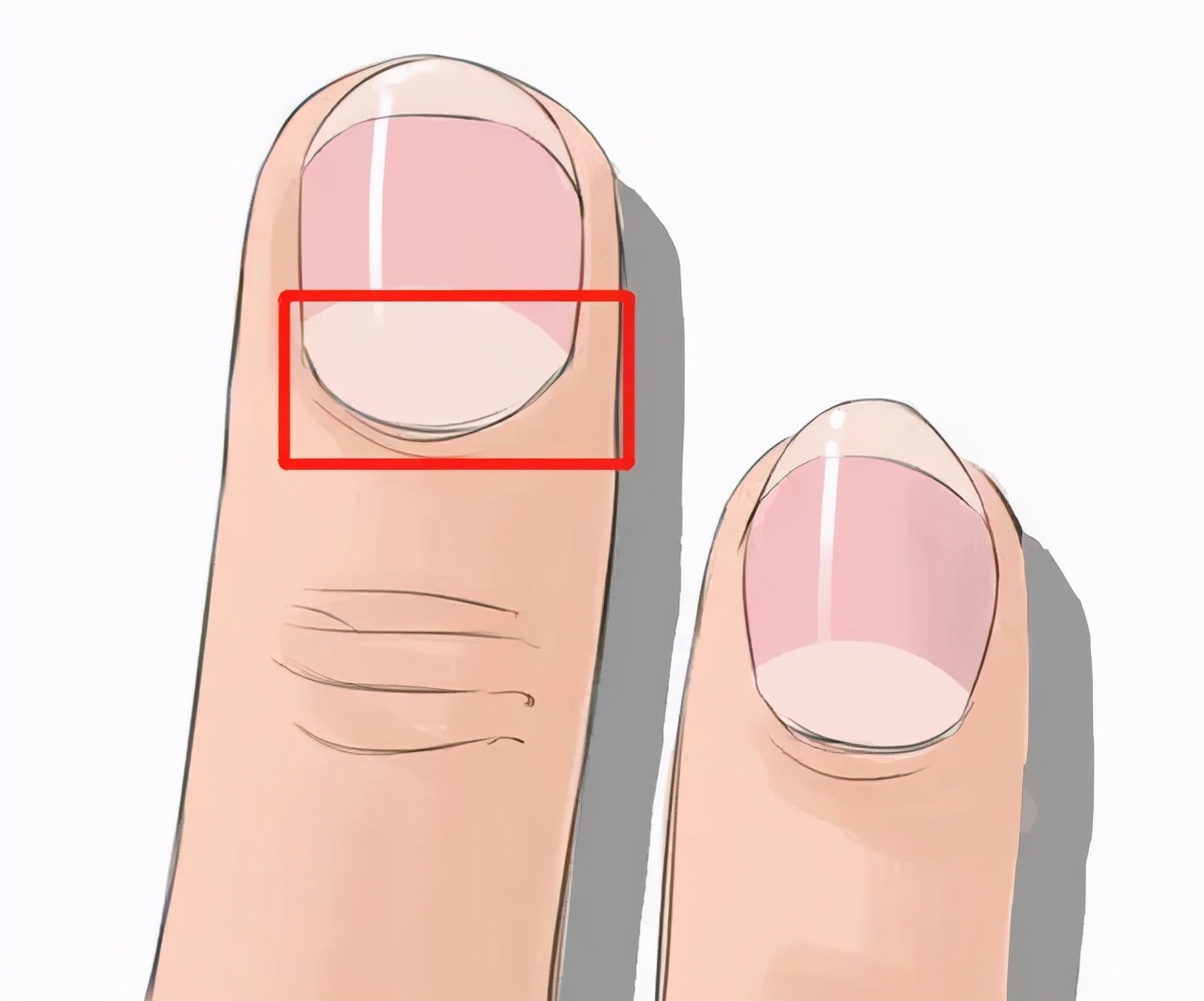 指甲上有条纹要警惕,指甲出现哪些症状是有问题的