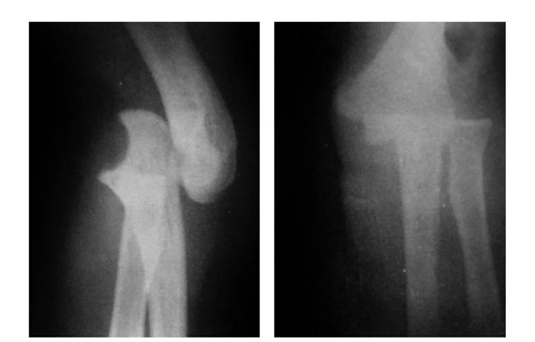 青少年肘部损伤最常见的是,肘部桡神经损伤的临床表现