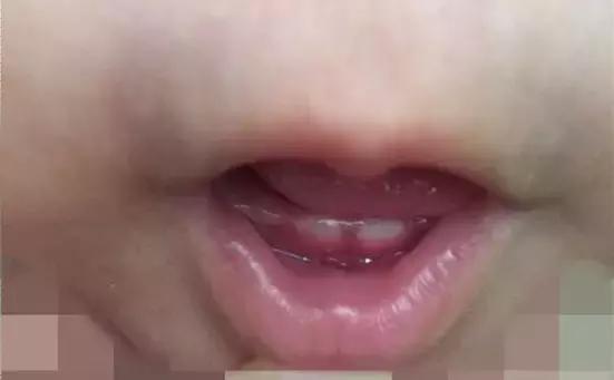 宝宝出牙征兆图片,宝宝出牙前不适后多久出牙