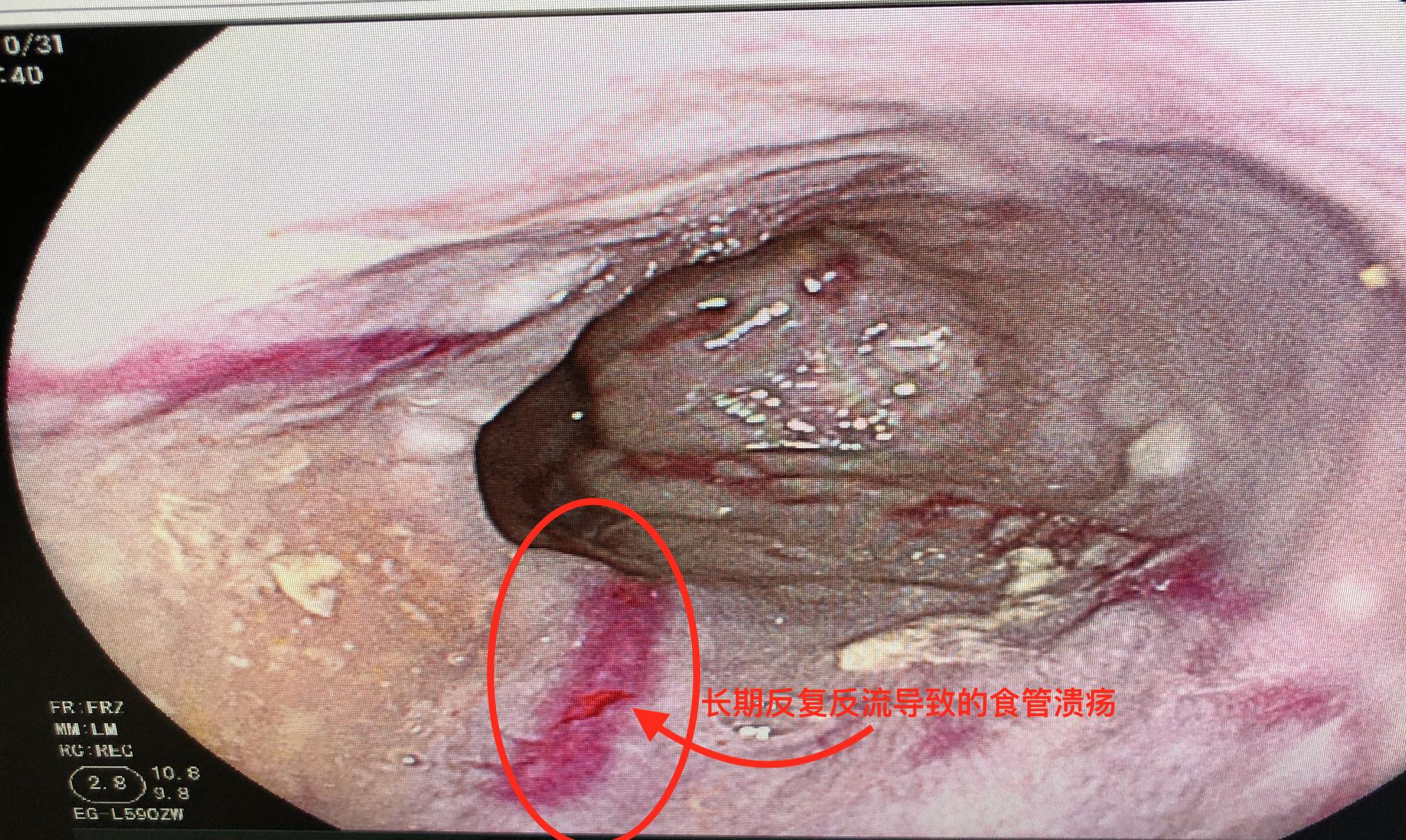 长期食物反流该怎么办,吃完饭食物反流到喉咙