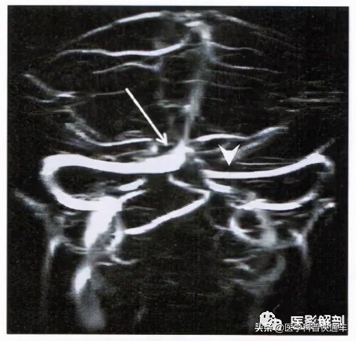 颅内静脉窦变异,颅内静脉窦变异I型什么意思