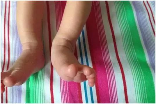 出生宝宝足内翻怎么办,宝宝出生脚外翻怎么办