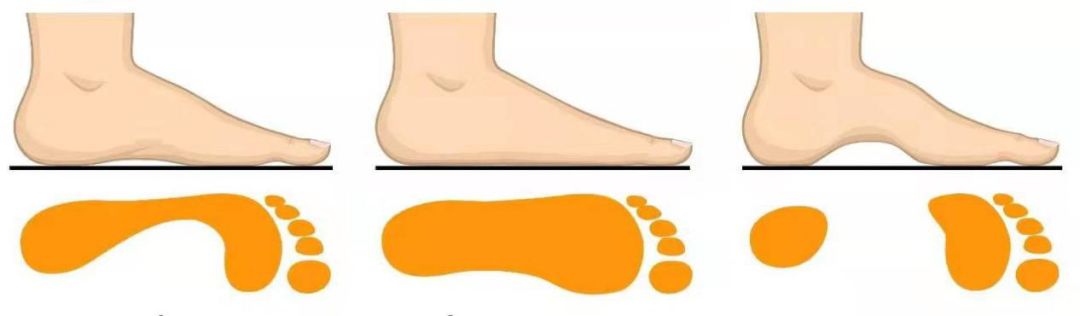 儿童扁平足的最佳治疗方法,全国治疗扁平足前十的医院