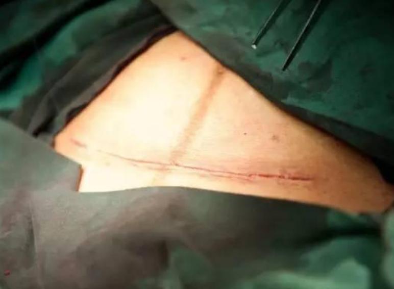 剖腹产不打麻醉备受折磨,剖腹产疼多久就彻底不疼了