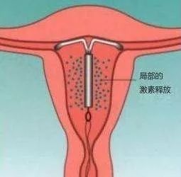 节育环过期一年未取的危害,节育环不取出到高龄有什么危害吗