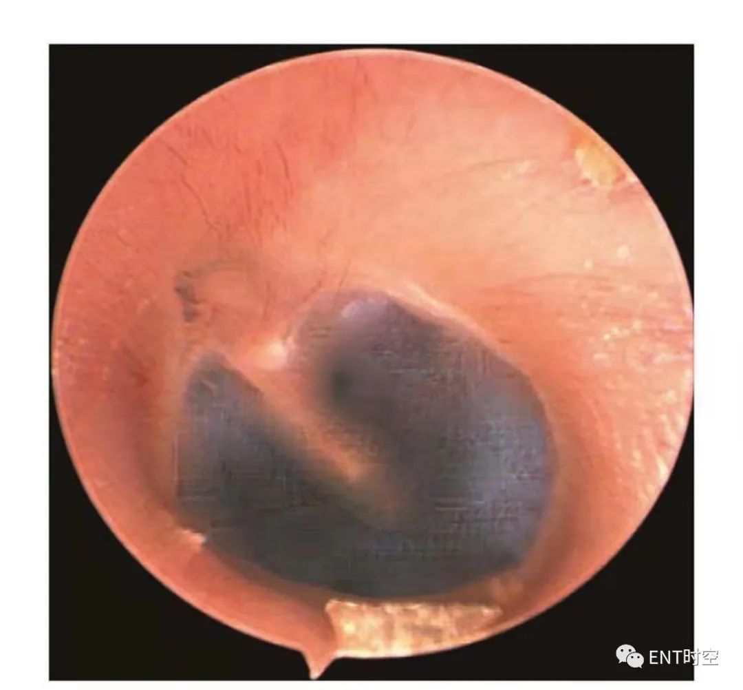 耳气压伤的症状和治疗方法,耳气压伤的常见原因