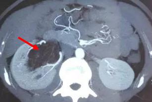 肾上长错构瘤怎么办,肾错构瘤是什么意思