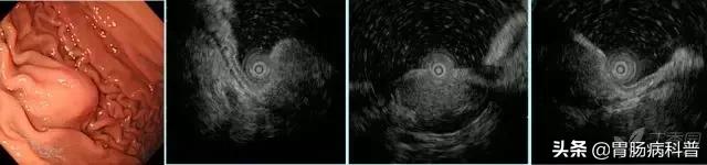 胃窦粘膜下隆起病变是胃癌吗,胃镜报告胃窦伴有隆起