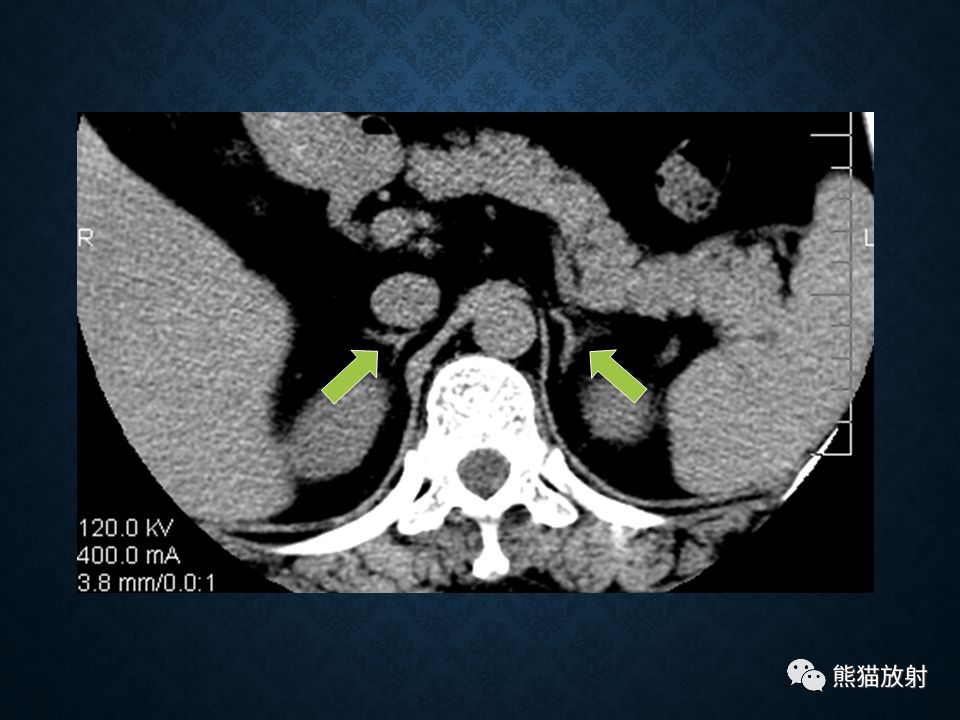 纵隔和肾上腺恶性肿瘤,纵隔性肿瘤位置图