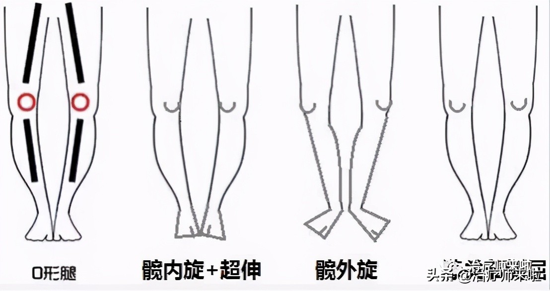 怎么让腿型改正,怎样使腿型变直