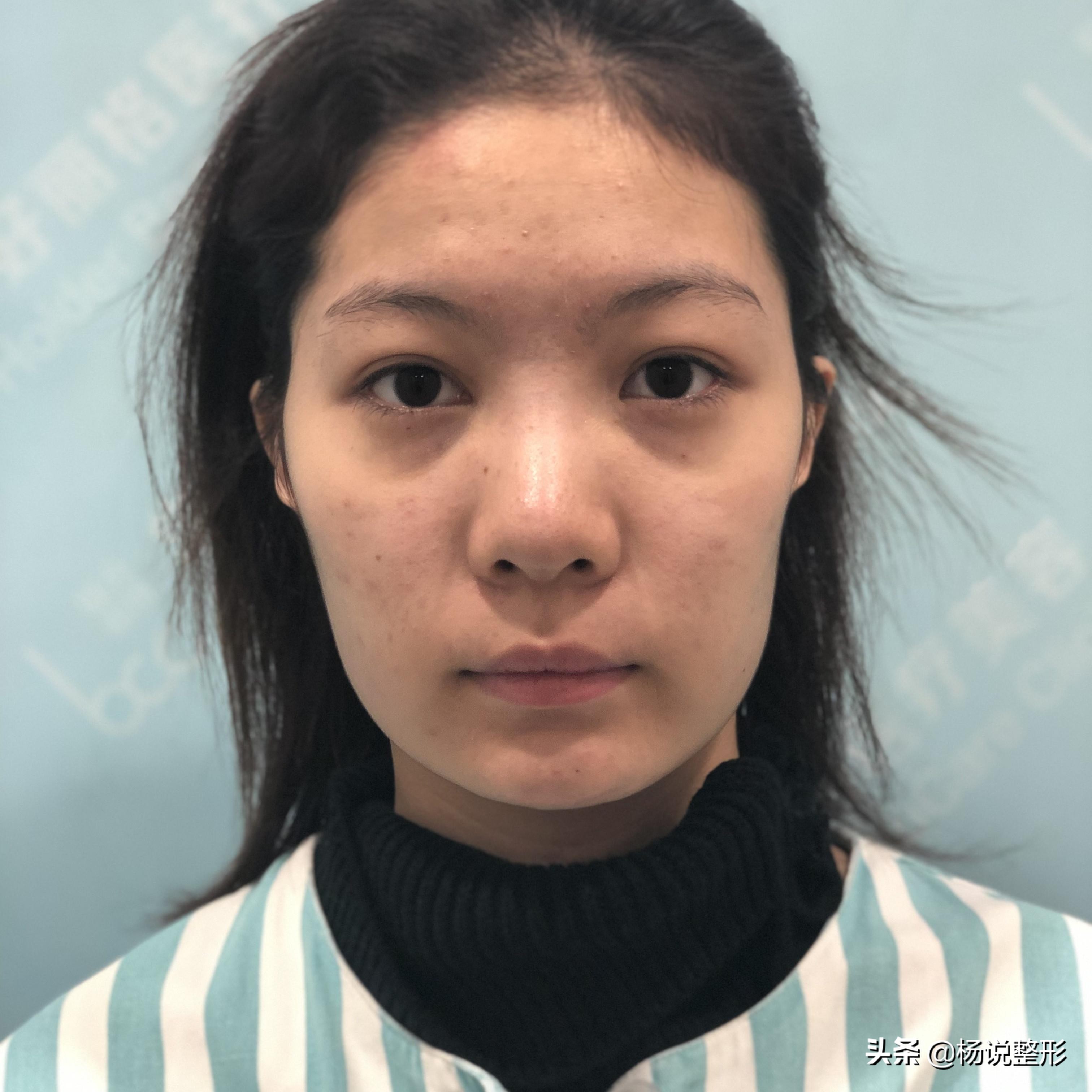 28岁做线雕提升脸部好不好,28岁女人做线雕现状