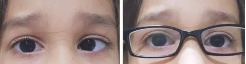 揭开斜视的面纱-内斜视