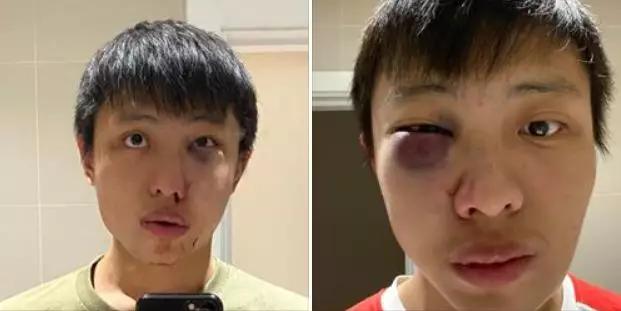 疫情华侨在国外被歧视,疫情期间海外华人的心酸