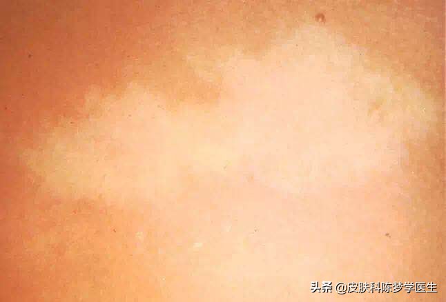 皮肤出现白斑吃什么好,皮肤发现白斑怎么办