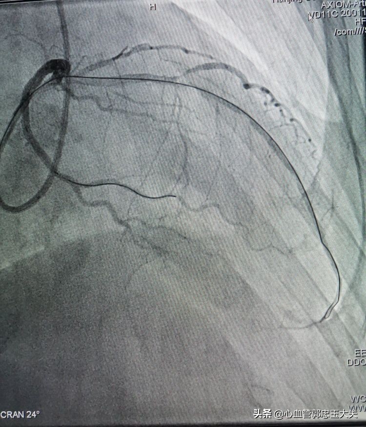 CTO遇到钙化病变怎样才能把血管打通?