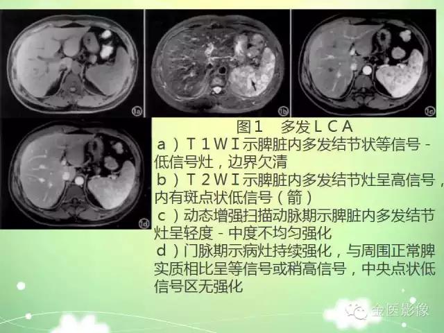 脾血管瘤中医辨证,脾血管瘤超声表现