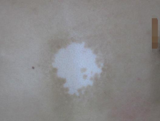 白癜风发展期怎么控制,关于白癜风的经验方