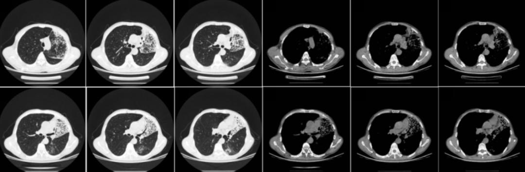 时隔一年再次住院,时隔一年旧病复发