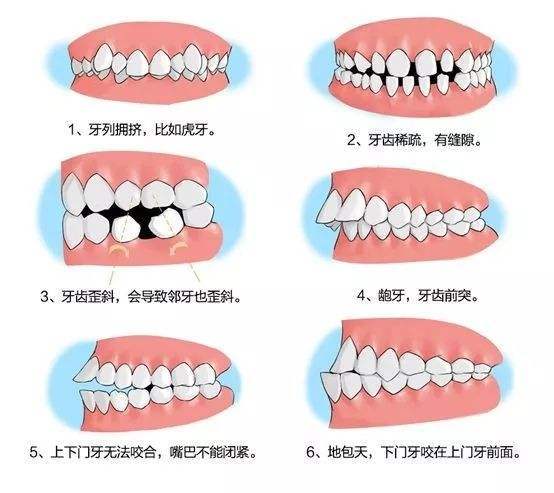 戴牙套不一定变好看,戴牙套难看吗