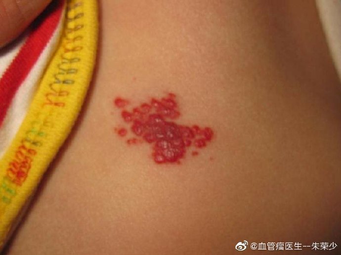 脑干海绵状血管瘤应该注意什么,脑海绵状血管瘤手术后注意事项