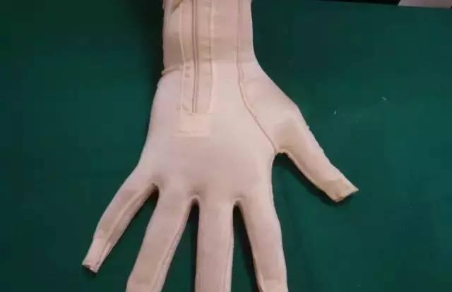 烧伤疤痕后遗症怎么治,烧伤愈合后疤痕处理案例