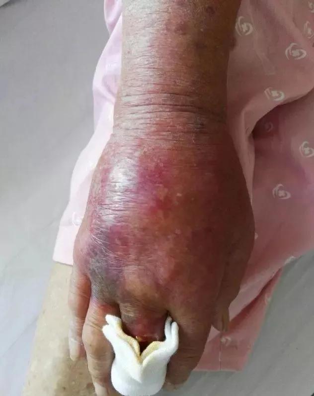 挤痘痘引发脑膜炎几率,挤痘痘会引发囊肿吗