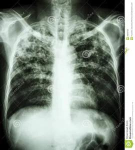 怀疑肺结核必须要做气管镜检查吗,痰里找到结核杆菌就说明肺结核吗