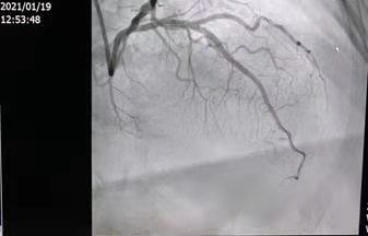 陕西冠脉介入手术,冠脉支架降价最新价格