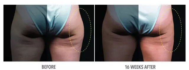 酷塑冷冻溶脂副作用是什么样的,酷塑冷冻溶脂的真实经历对比