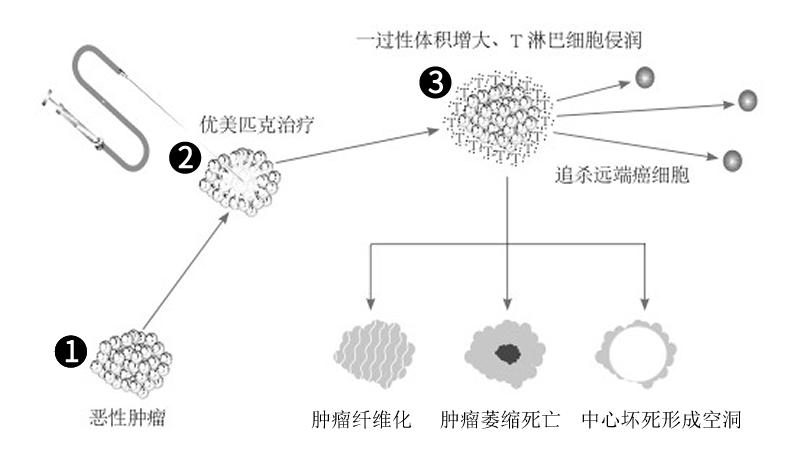 巨型肝癌从查出到死真实情况,肝癌10厘米治愈案例