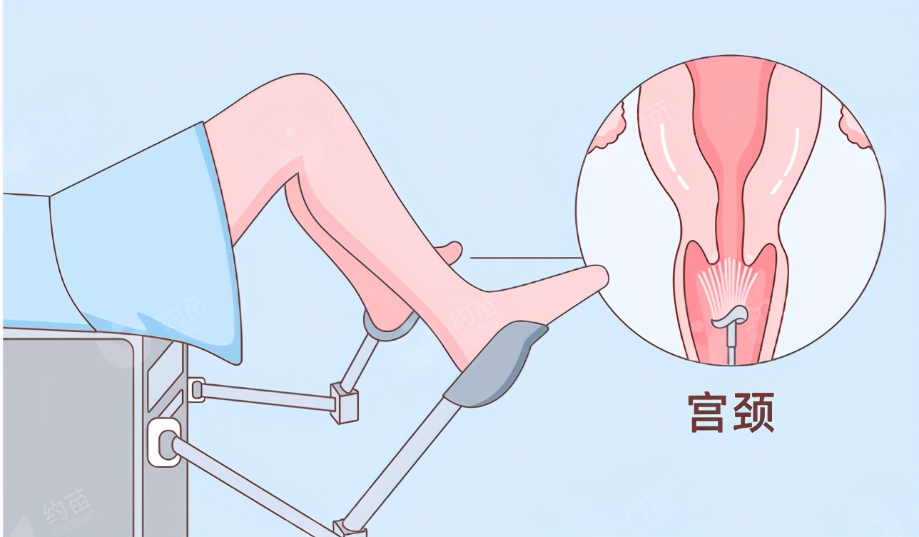 宫颈癌筛查e6e7阳性是什么意思,宫颈癌筛查39阳性会传染给男方吗