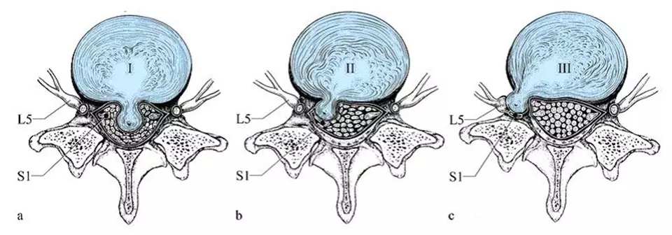 颈椎腰椎疾病ct及mri诊断,腰椎ct可以发现肠部病变吗