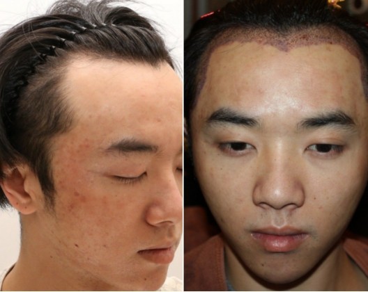 为什么华晨宇植发效果好,华晨宇植发图片是真的吗