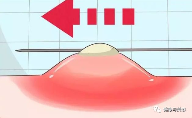 38岁阿娇沉迷于祛痘、去黑头的教学，居然很实用